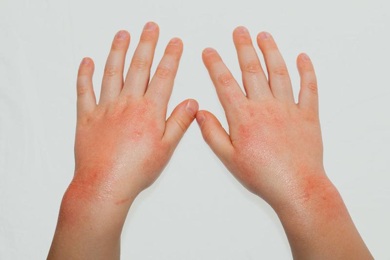 Atopic Dermatitis Market is set to hit US$ 25.00 billion growing