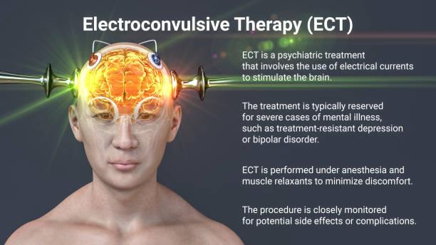 Electroconvulsive Therapy Market Expected to Expand at a Steady