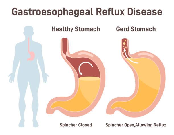 Gastroesophageal Reflux Disease Treatment Devices Market