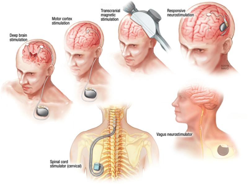 Neuromodulation Market