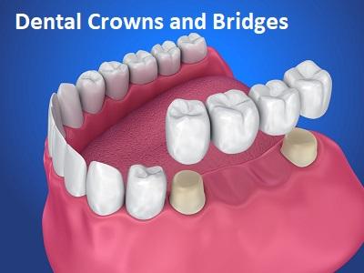 Dental Crowns and Bridges Market