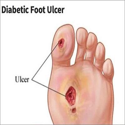 Diabetic Ulcer Treatment Market