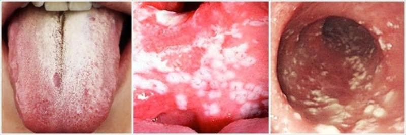 Oropharyngeal Candidiasis Market, Business Growth,