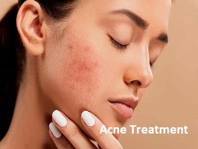 Acne Treatment Market