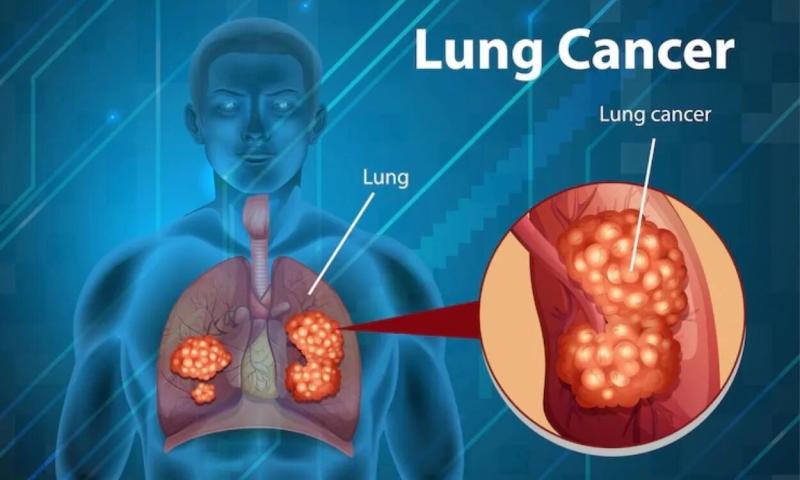 Lung Cancer Diagnostic And Screening Market