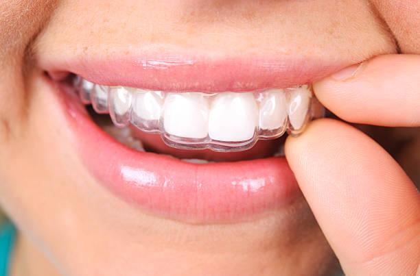 Clear Aligners Market Size and Share 2024-2031 Detailed