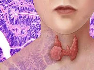 Anaplastic Thyroid Cancer Treatment Market