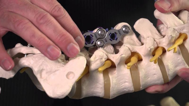 Spinal Implants And Devices