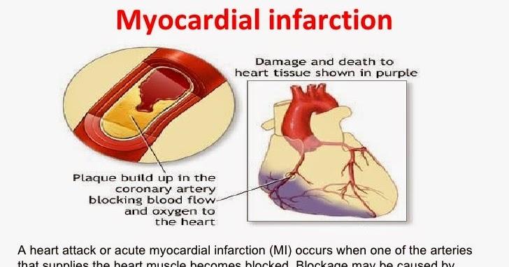 Analyzing the Global Myocardial Infarction Drug