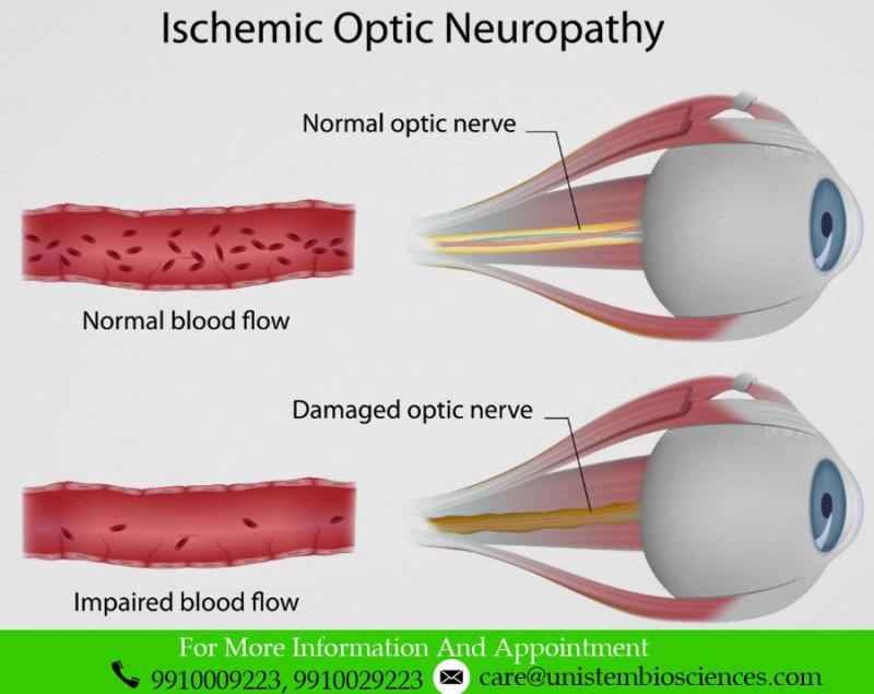 Optic Neuropathy Drug