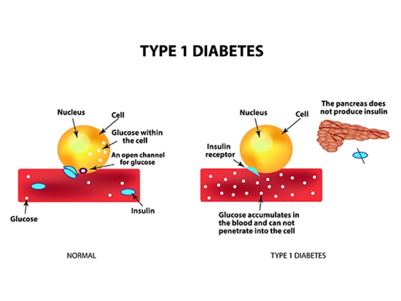 Type 1 Diabetes Market Business Strategies, Development