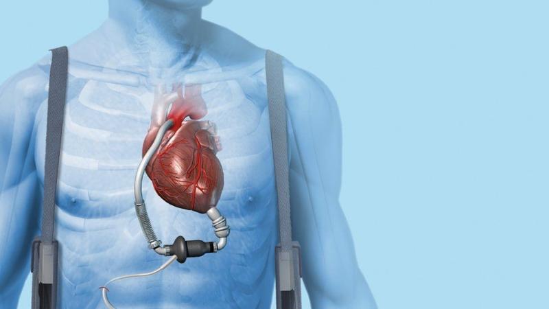 Heart Pump Devices