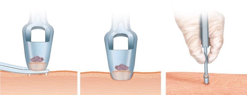 Skin Biopsy Market