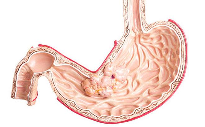 Stomach Cancer Drugs Market