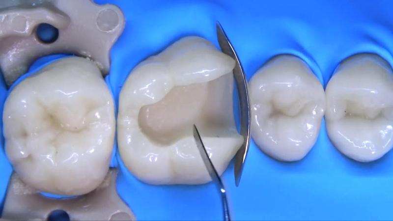 Composite Filling in Dental Restoration