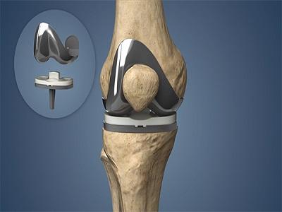 Joint Replacement Devices Market
