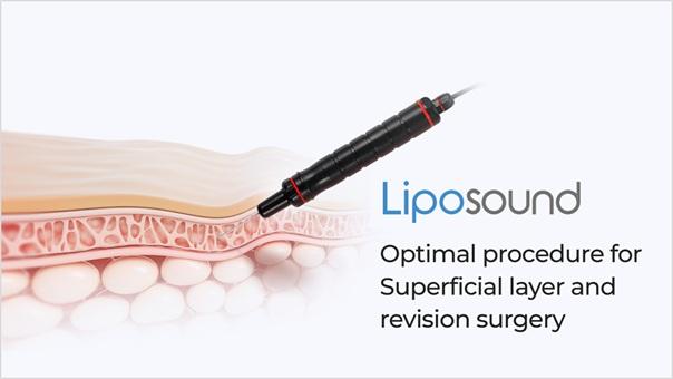 Ultrasound Liposuction: Advanced Body Contouring for Safe and Precise Fat Removal | Newpong