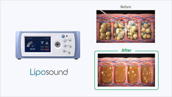 Ultrasound-assisted Lipolysis Device for Body and Facial Contouring | Newpong