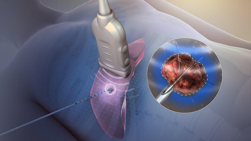 Tumor ablation devices
