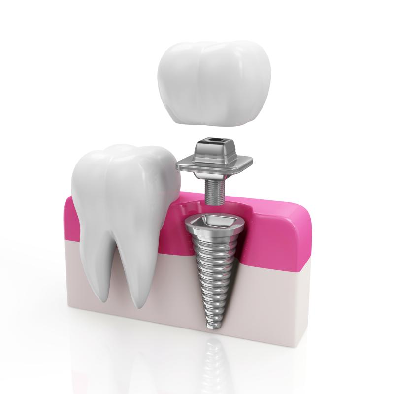 Dental Articulators Market