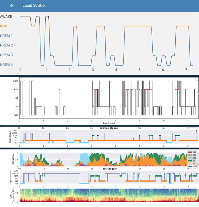 INSPEC's Camera-Based REM Detection Matches Clinical EEG Sleep Staging