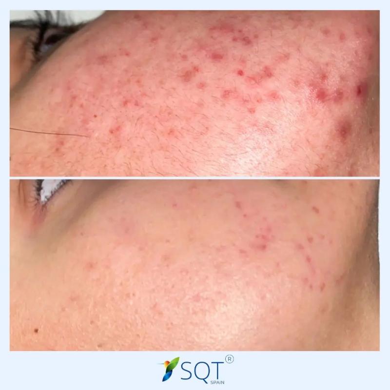 What causes acne? Is biomicroneedling safe and effective? How does it work?