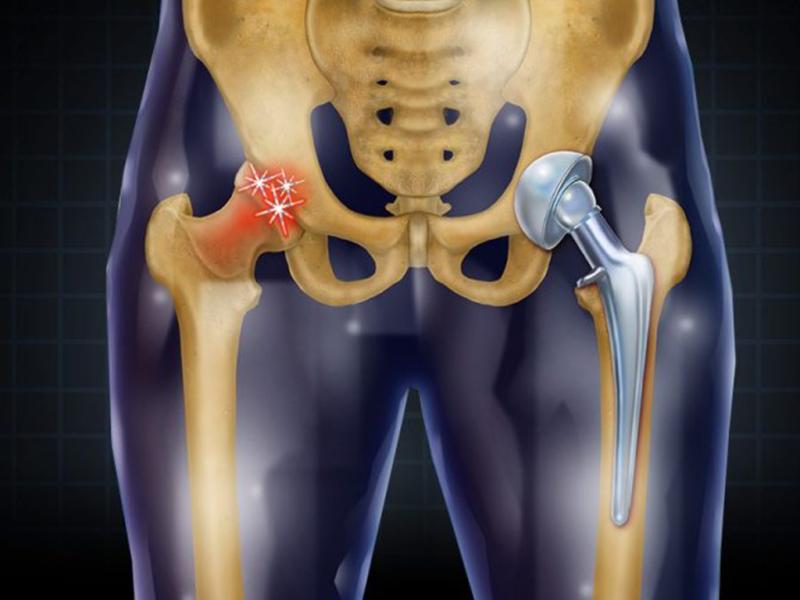 Hip Replacement Market Development, Industry Trends, Demand and Growth Analysis and Forecasts 2033