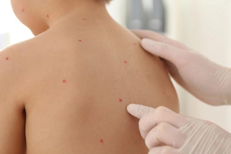 Varicella Zoster Infections Treatment Market Innovation Accelerates Through Biologics, Vaccines, and Cold Chain Infrastructure
