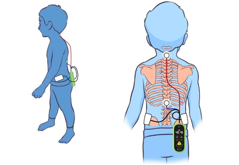 Neural Modulation Devices Market Statistical Forecast, Trade