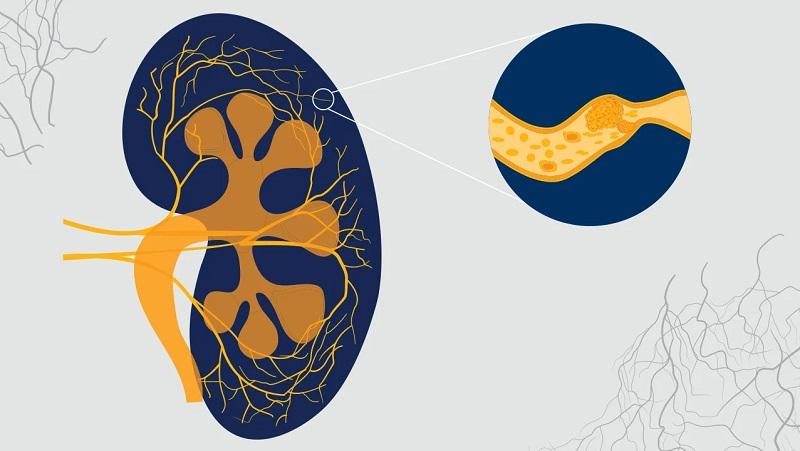 Atypical Hemolytic Uremic Syndrome Treatment Market Set to Reach New Heights with Pipeline Innovations and FDA Approvals