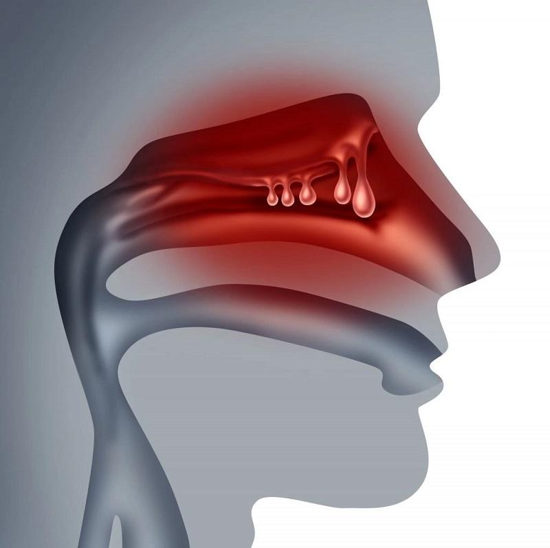Nasal Polyposis Drugs Market Growth Fueled by Tezspire Phase III Win & Depemokimab FDA Submission | Mylan N.V., GlaxoSmithKline PLC, Lupin, Sanofi S.A