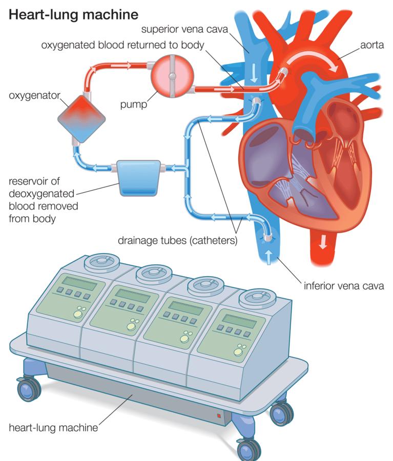 Heart Lung Machine Market