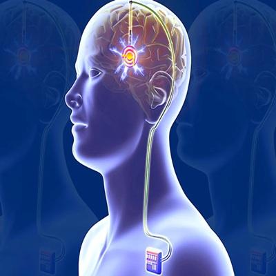 North America Deep Brain Simulation Market & Growth, Trends Highlighted Until 2030