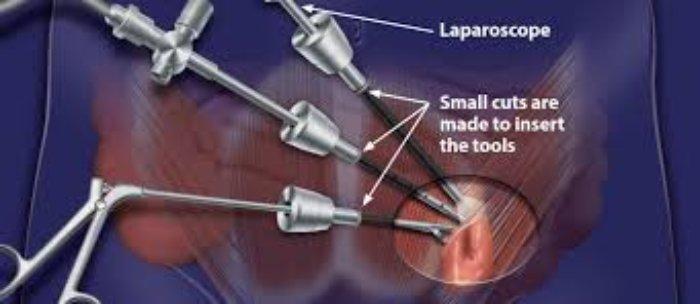 Hernia Repair Devices Market Report Industry Insights, Share,