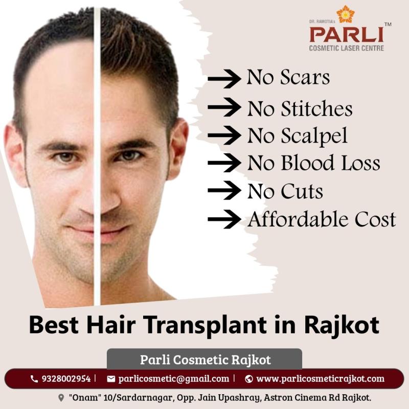 Hair Transplant in Rajkot, Hair Transplant Specialist in Rajkot, Hair Transplant Treatment in Rajkot