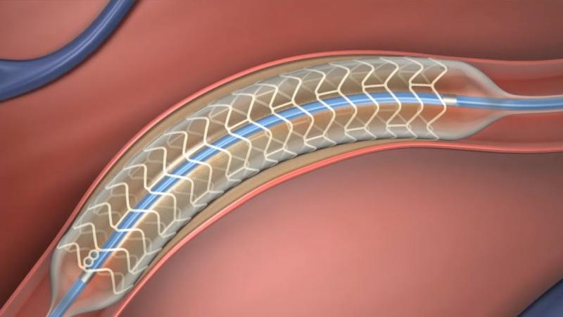 Bioabsorbable Stents Market to Reach US$ 1.1 Bn by 2032, Reports Persistence Market Research