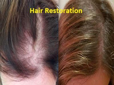 Hair restoration market lays foundation for further growth