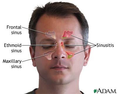 Sinusitis Market is expected to reach USD 6.6 billion by 2034
