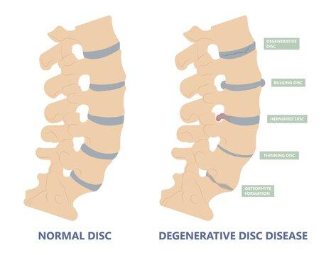 Lumbar Degenerative Disc Disease Market Thrives on Regenerative Spine Therapies & Japan's Robotic Surgery Growth | Sorrento Therapeutics, SpineThera, Eliem Therapeutics, Scilex Holding