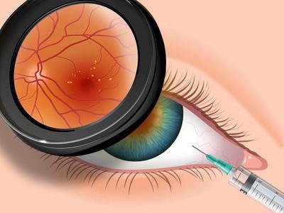 Macular Degeneration Treatment Market