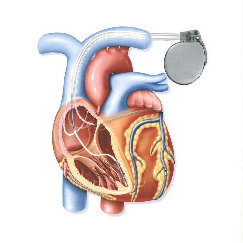 Cardiac Resynchronization Therapy Market Booming Worldwide