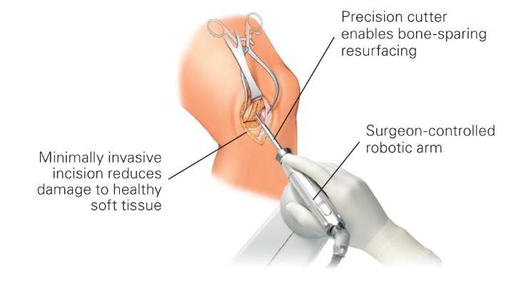 The soft tissue repair market is booming worldwide