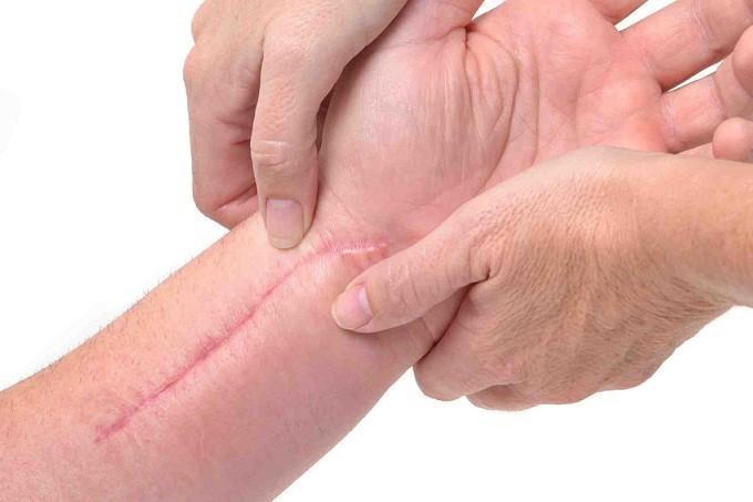 Keloid Treatment Market Evolves with Advanced Modalities and Patient-Focused Solutions | Major Companies are Novartis AG, GlaxoSmithKline Plc., RXi Pharmaceuticals Inc.,