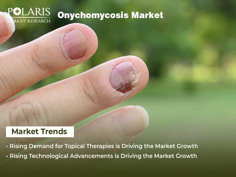 Onychomycosis Market