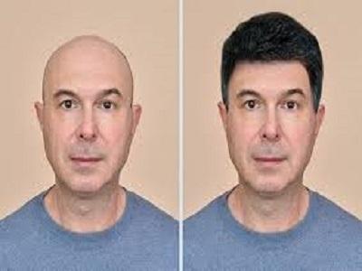 The hair restoration services market could see major changes