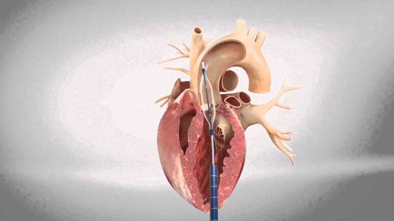 Heart Valve Devices Market Shows Strong Potential for Future Expansion | Leading Players are Abbott, Medtronic & Boston Scientific Corporation.