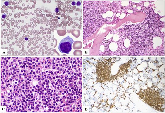 Waldenstrom Macroglobulinemia (Lymphoplasmacytic Lymphoma)