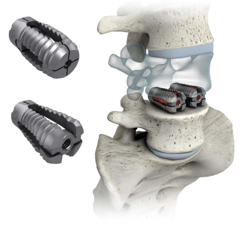 Lumbar Disc Replacement Devices Market Poised for Strong Growth at 13.5% CAGR, Driven by Rising Demand for Minimally Invasive Spine Surgeries