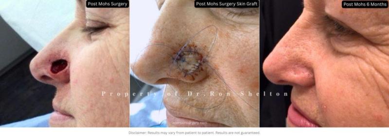 In the summer, prevention should be everyone's first line of defense-but if skin cancer does occur, Mohs surgery offers the best c