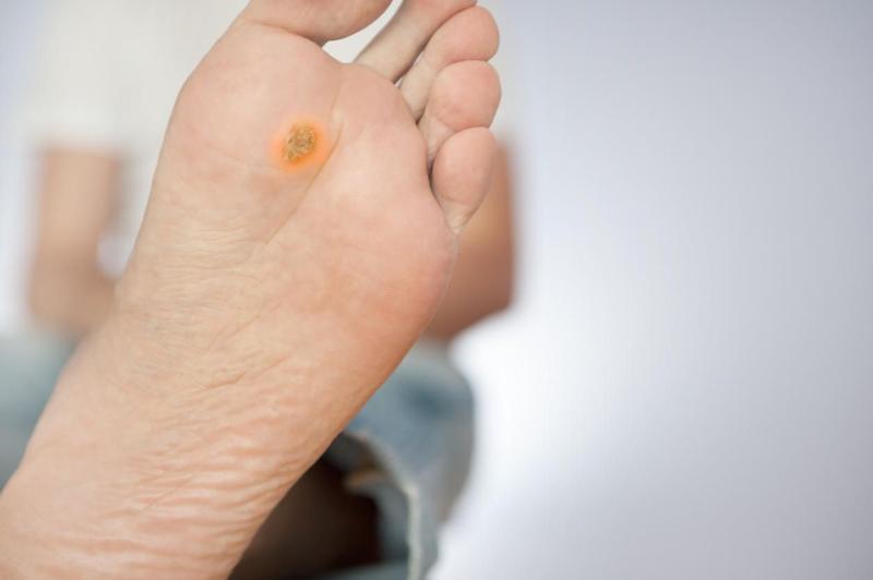 Diabetic Foot Ulcers Market Outlook: Advanced Care Solutions Transforming Treatment